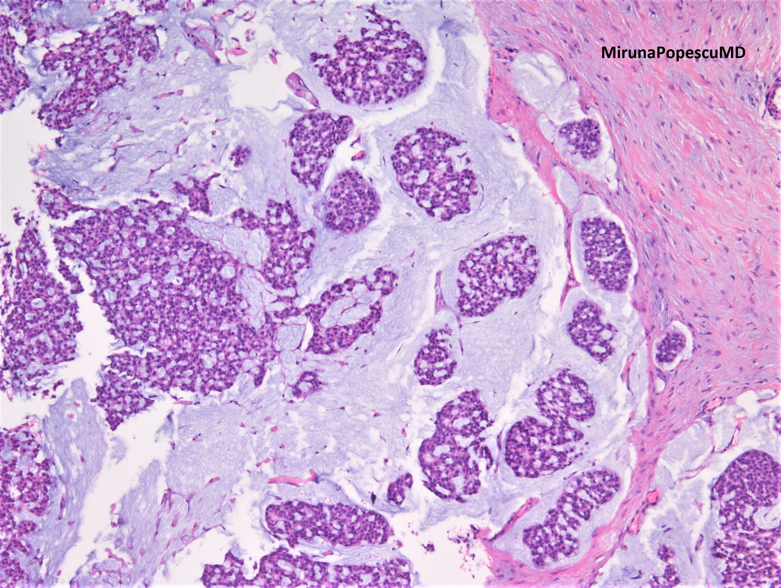 Mixed Mucinous Carcinoma With IBC NST CNB Specimen KiKo XP